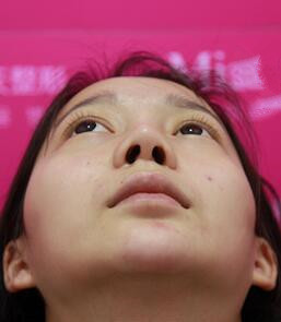 隆鼻修复术后恢复期经历