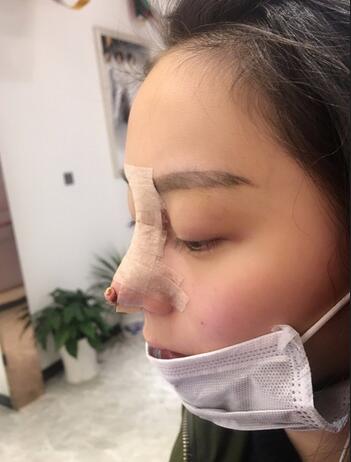 隆鼻修复术后恢复期经历