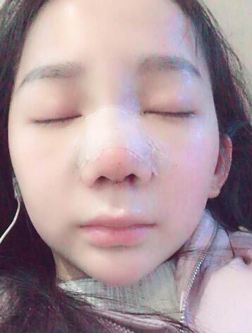 隆鼻修复术后恢复期经历