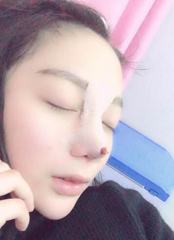 隆鼻修复术后恢复期经历