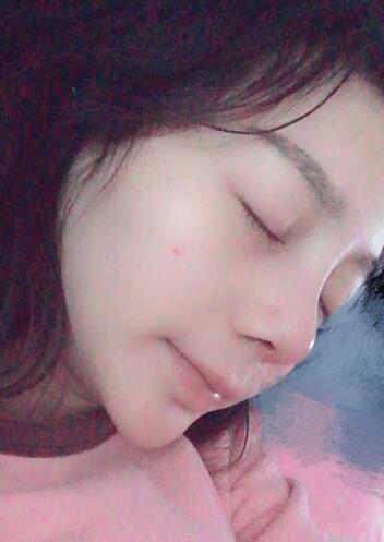 隆鼻修复术后恢复期经历