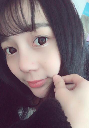 隆鼻修复术后恢复期经历