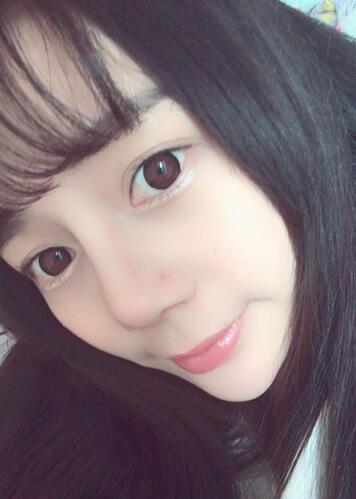 隆鼻修复术后恢复期经历