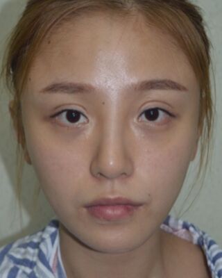 自体脂肪面部填充恢复 少女感十足哟