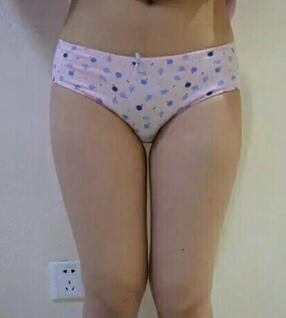 大腿吸脂40天果