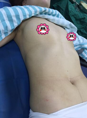 自体脂肪隆胸2个月真实经历