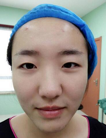 全切双眼皮2个月恢复图