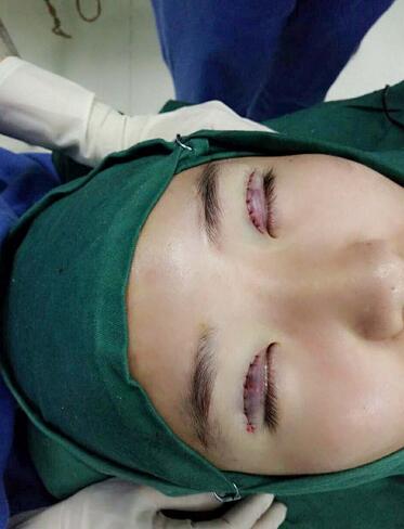 全切双眼皮2个月恢复图