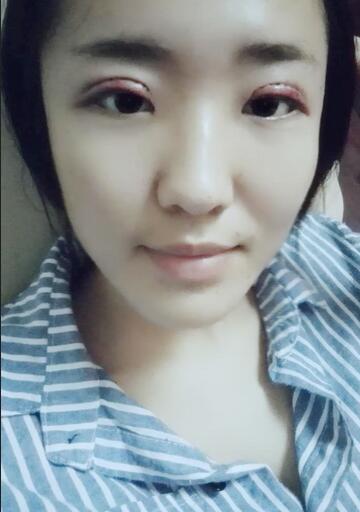 全切双眼皮2个月恢复图