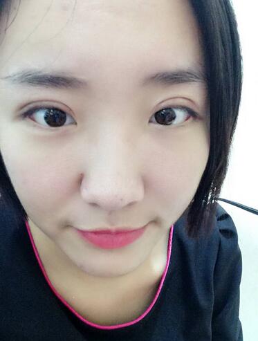 全切双眼皮2个月恢复图