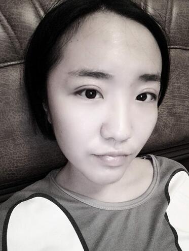 全切双眼皮2个月恢复图