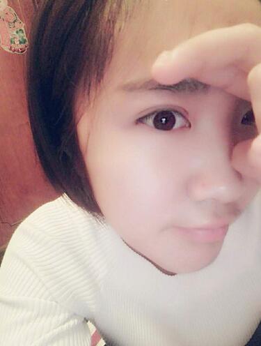 全切双眼皮2个月恢复图