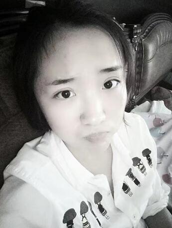 全切双眼皮2个月恢复图