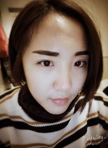 全切双眼皮2个月恢复图