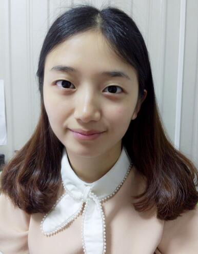 微创双眼皮恢复过程图