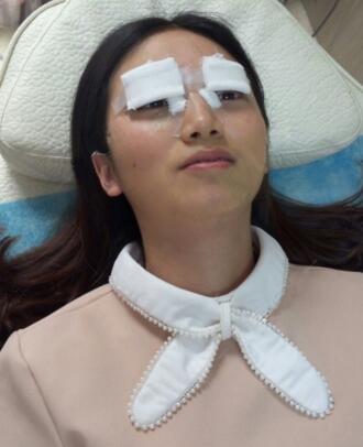 微创双眼皮恢复过程图