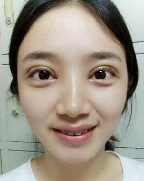 微创双眼皮恢复过程图