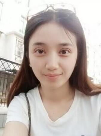 微创双眼皮恢复过程图