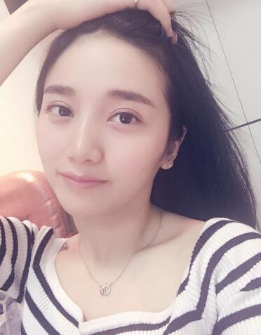 微创双眼皮恢复过程图