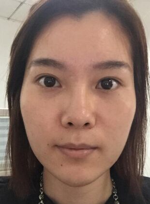 自体脂肪填充面部经验分享一下