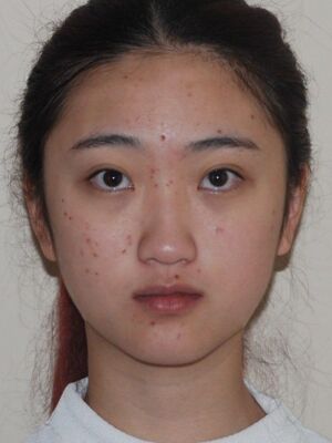 膨体隆鼻+垫鼻尖前后对比图，拥有小巧美鼻