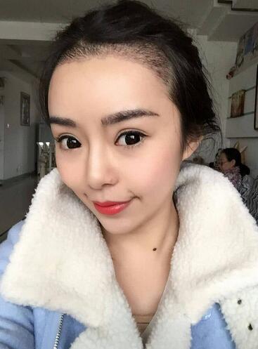 发际线调整案例分享 北京熙朵发际线+眉毛种植