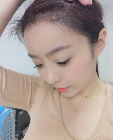 发际线调整案例分享 北京熙朵发际线+眉毛种植