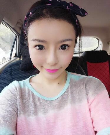 发际线调整案例分享 北京熙朵发际线+眉毛种植