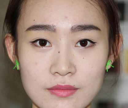 种植眉毛后二年图片