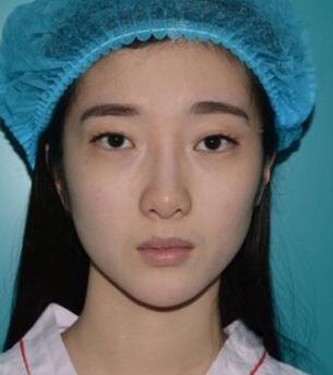 双眼皮修复+自体脂肪填充恢复日记