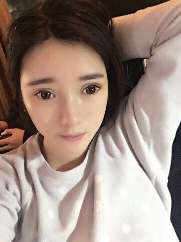 双眼皮修复+自体脂肪填充恢复日记