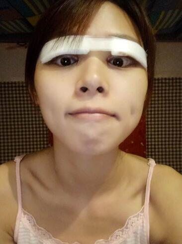 北京熙朵全切双眼皮1个月恢复日记