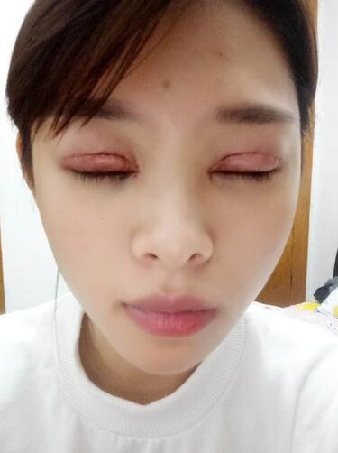 北京熙朵全切双眼皮1个月恢复日记