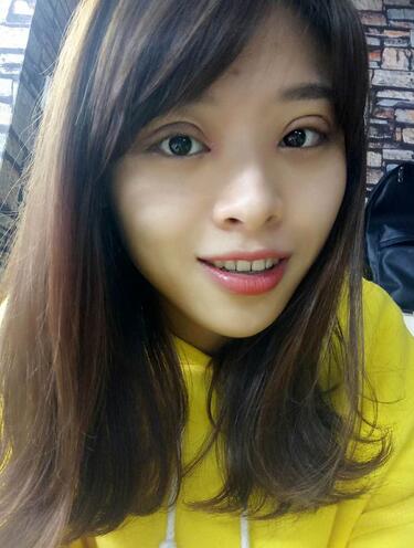 北京熙朵全切双眼皮1个月恢复日记