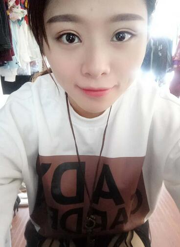 北京熙朵全切双眼皮1个月恢复日记