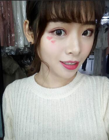 北京熙朵全切双眼皮1个月恢复日记