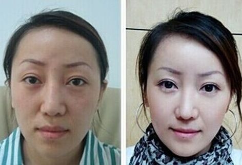 南昌水光补水多少钱一针、水光补水成好吗