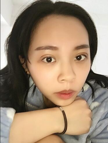 双眼皮恢复过程图