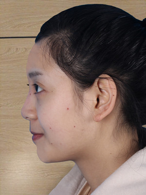 自体软骨隆鼻手术前后过程以及对比照片分享