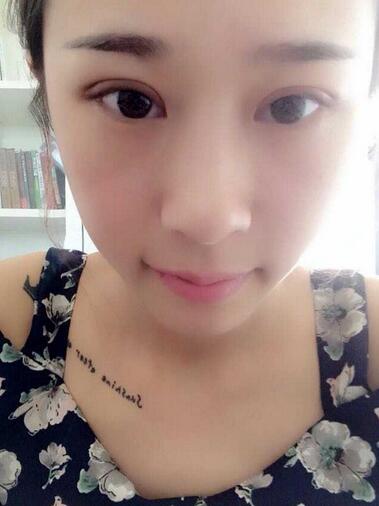 切开双眼皮消肿过程图