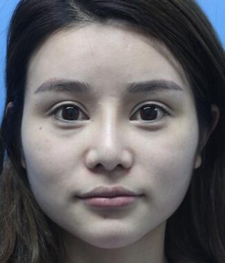 自体脂肪填充后恢复图 孟明星自体脂肪面部填充