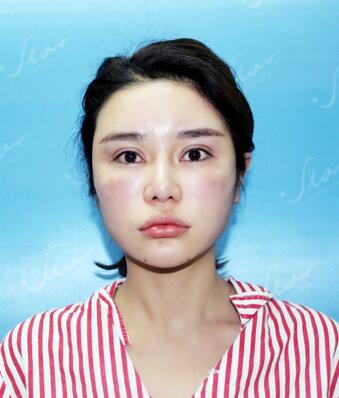 自体脂肪填充后恢复图 孟明星自体脂肪面部填充