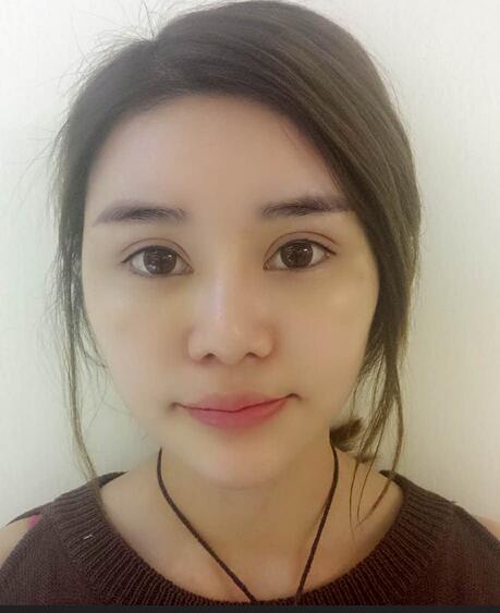 自体脂肪填充后恢复图 孟明星自体脂肪面部填充