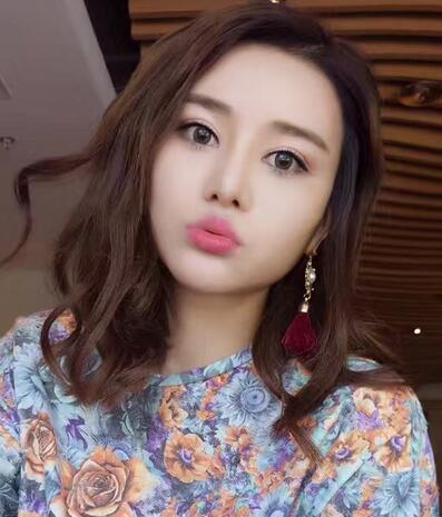 自体脂肪填充后恢复图 孟明星自体脂肪面部填充