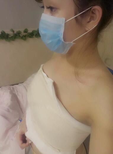 自体脂肪隆胸2个月经历