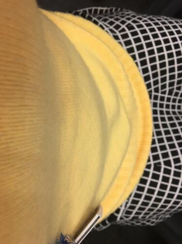 腰腹部吸脂后一个月照片