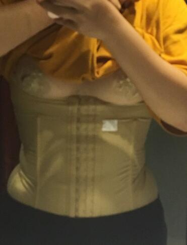 腰腹部吸脂后一个月照片