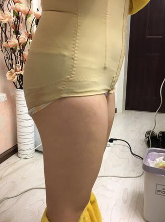 腰腹部吸脂后一个月照片