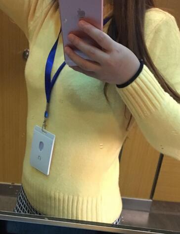 腰腹部吸脂后一个月照片