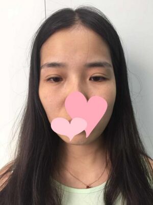 修复失败双眼皮真实案例 果断分享给大家